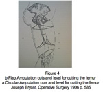 a) Incisions  pratiquer selon la mthode circulaire et hauteur de lamputation du fmur; b) Incisions  pratiquer selon la mthode Neumann et hauteur de lamputation du fmur