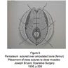 Suture du prioste par-dessus los amput 