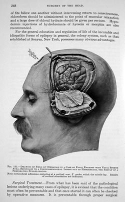 [ Epilepsy as the result of a perforating bullet wound ]